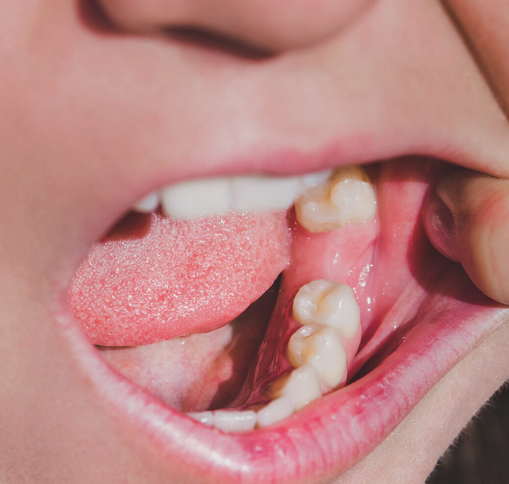 Treatment -  Belmont House Dental